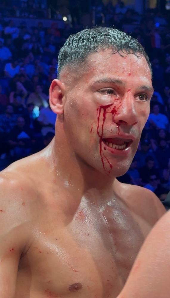 Víctor Rodríguez recibió severo daño en el rostro, por lo que no pudo continuar en el combate...