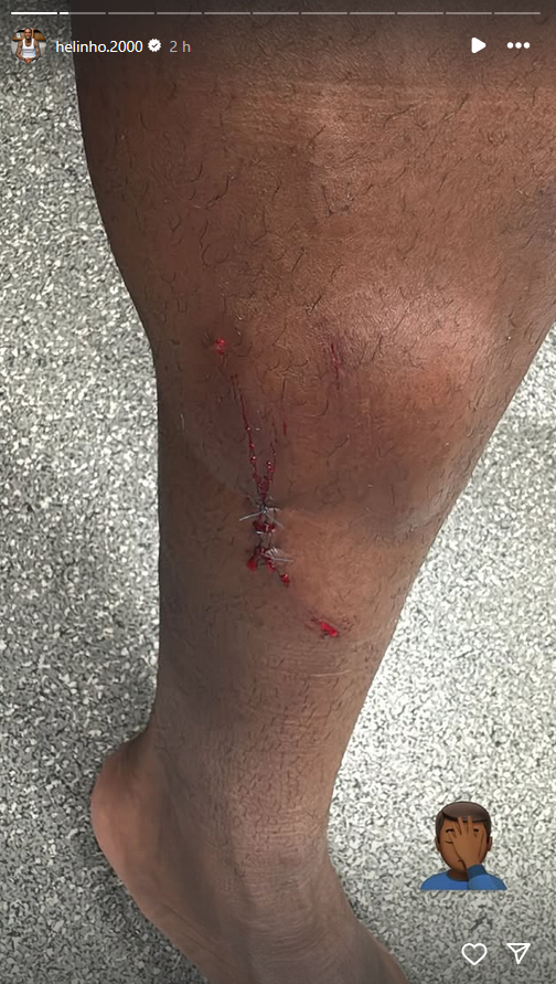 Helinho muestra la gravedad de su lesión. | Foto Instagram: helinho.2000