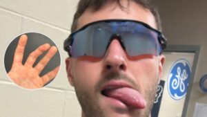 ¡Qué dolor! Santiago Gimenez muestra imágenes de su fuerte lesión en el dedo en la final de la Copa Oro