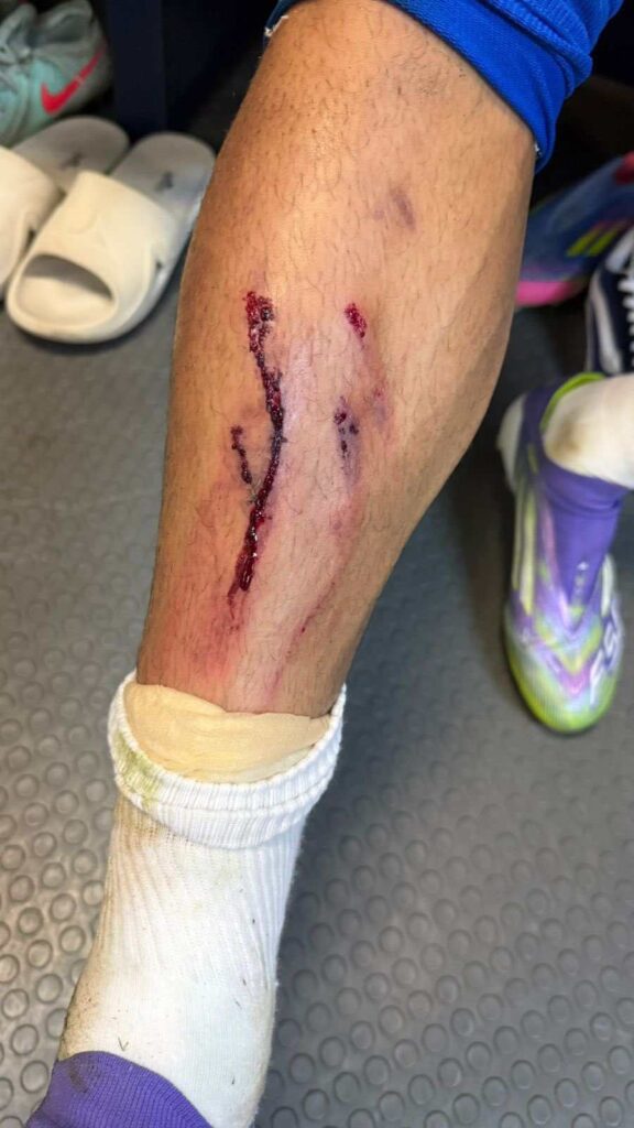 Herida de Chiquete tras la acción ante Pachuca