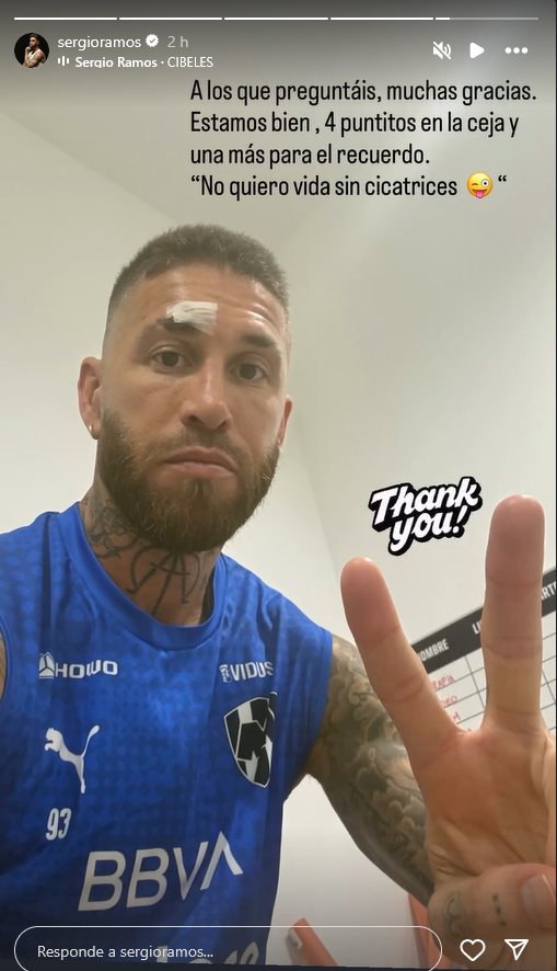 Sergio Ramos muestra sus puntos en el rostro. Foto Instagram: @sergioramos

