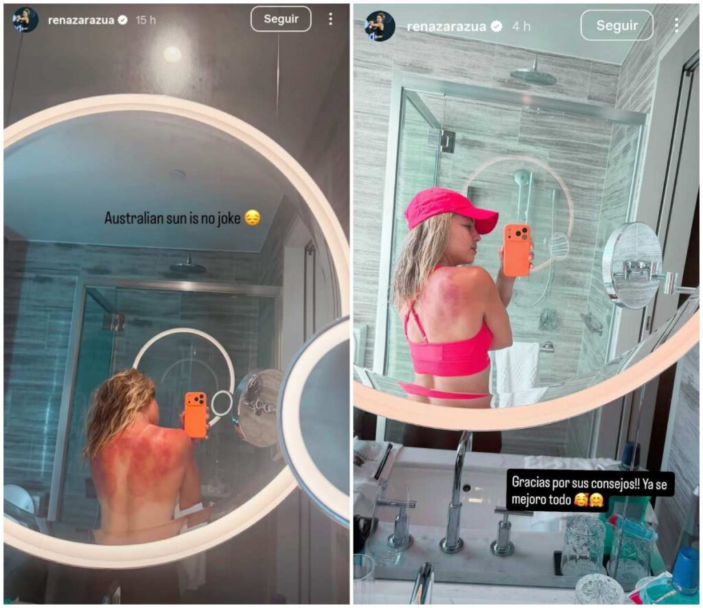 Renata Zarazúa muestra quemaduras por el sol en Australia