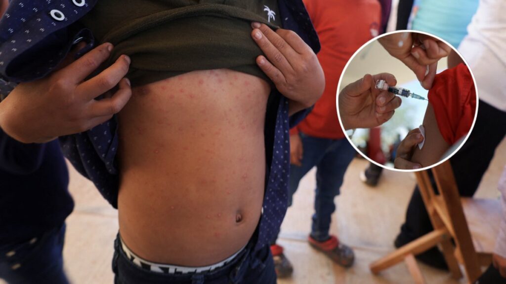 Lanzan alerta epidemiológica por sarampión. Reuters