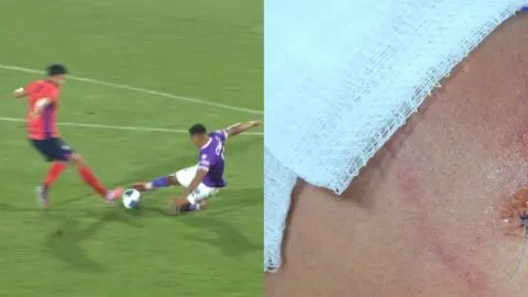 Impactante: Así quedó la rodilla de Carlos Castrillo tras la entrada sufrida ante Municipal