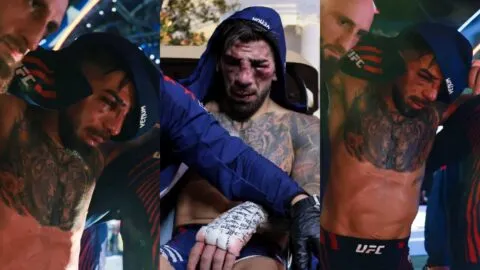 Así quedó el rostro de Ilia Topuria tras caer ante Justin Gaethje en UFC Freedom 250