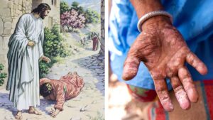 De la Biblia a la ciencia, ¿cómo cambió la forma de ver la lepra?