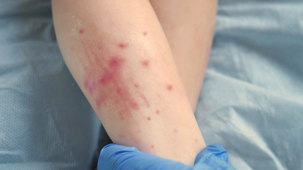 sarampion-mexico-emite-alerta-preventiva-de-viaje-a-eu