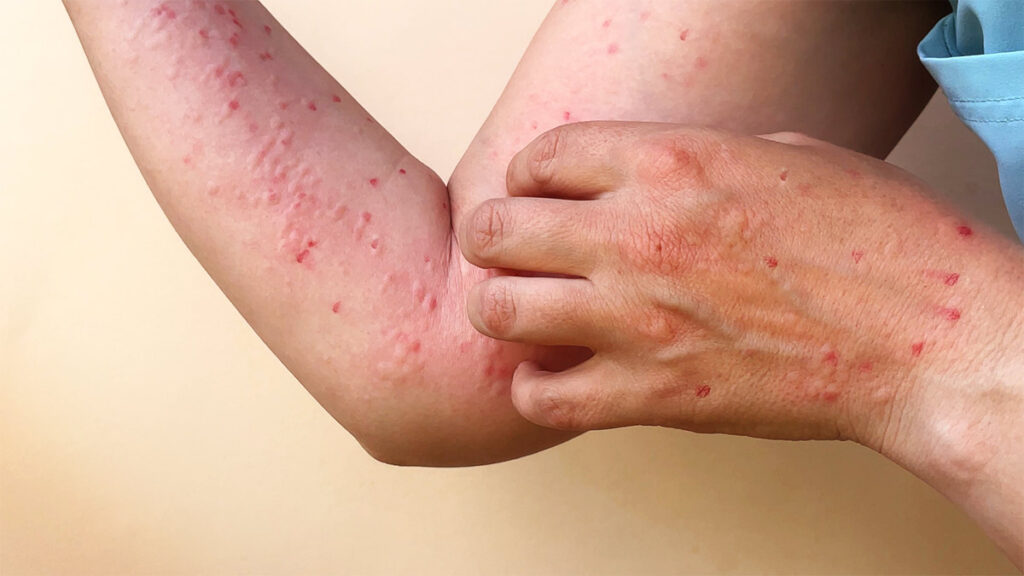 Mpox no ha desaparecido de Estados Unidos y casos aumentan