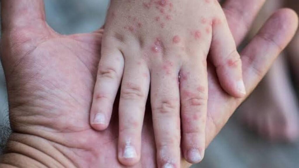 VIRUS COXSACKIE oaxaca