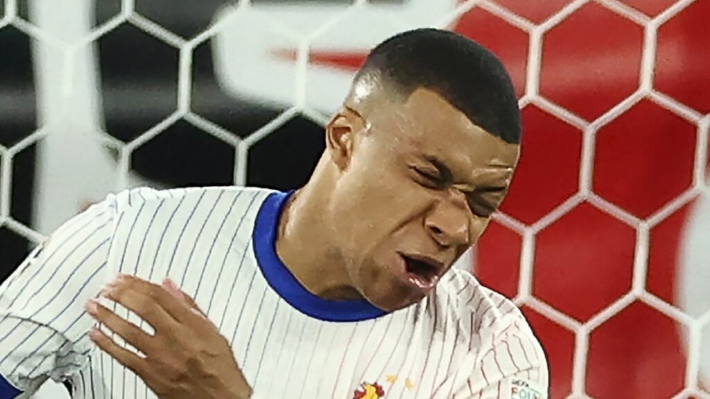 Kylian Mbappe Se Fractura La Nariz