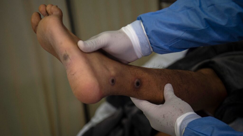 Mpox Sintomas Diferencias viruela mono