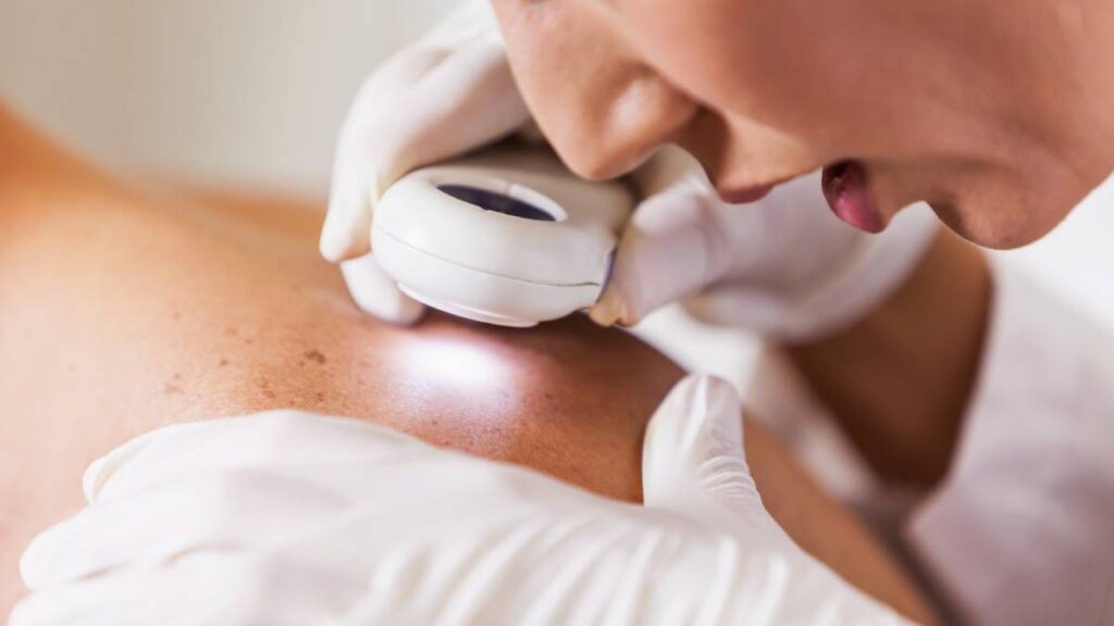 Cáncer de piel, estos son los síntomas de la enfermedad que padece Mau Nieto