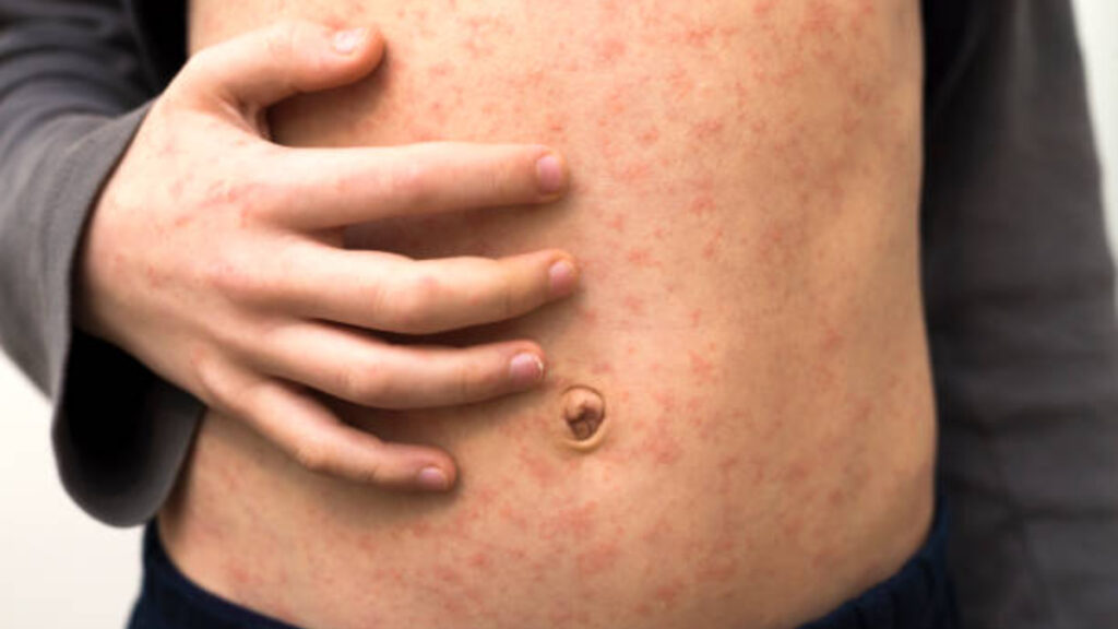 ¿Cuál es el estado con más casos de sarampión en México?