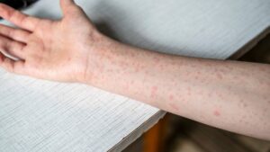 ¡Atención en Michoacán! Detectan sarampión en tres menores de Maravatío y activan cerco sanitario