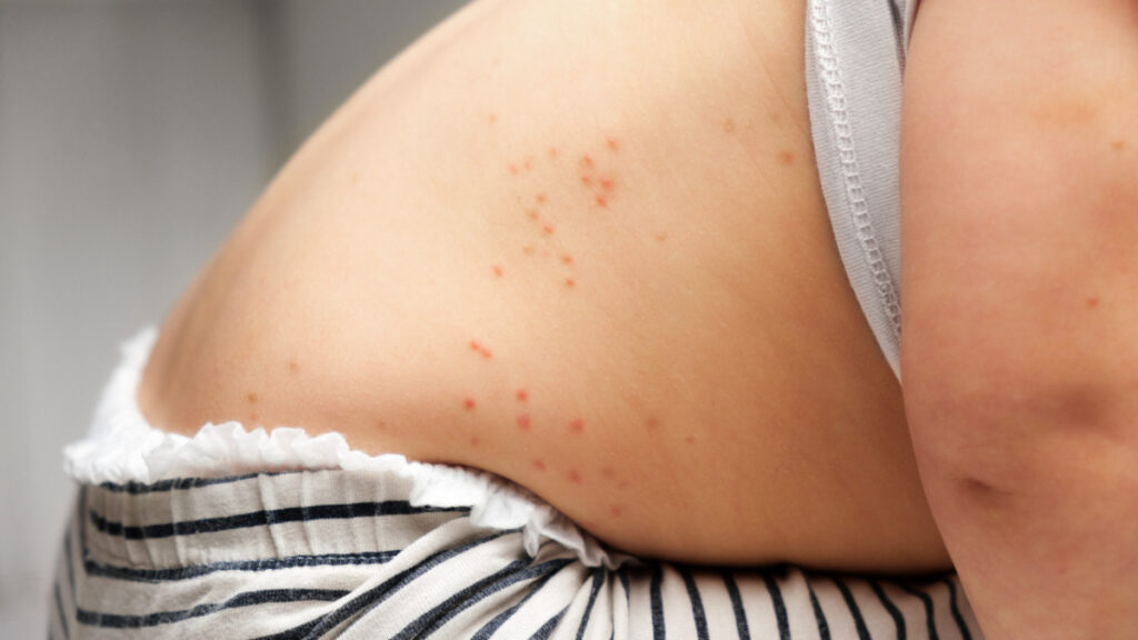 ¿Cuántos casos confirmados de sarampión hay en México?