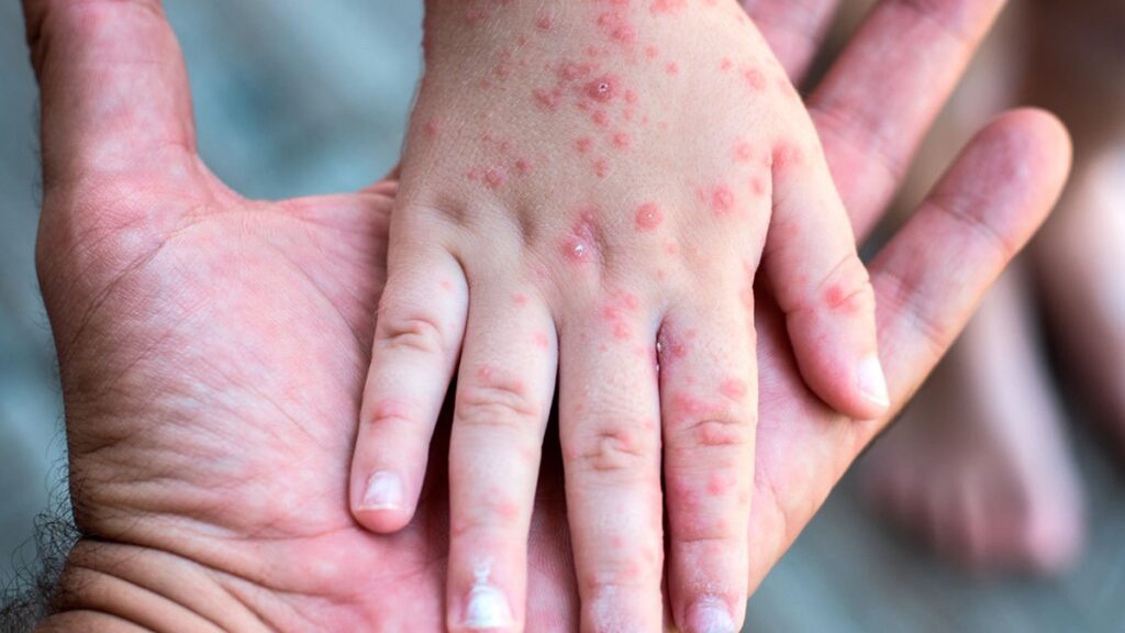 Niña muere por sarampión en Cajeme; ¿cuántos casos hay en Sonora?