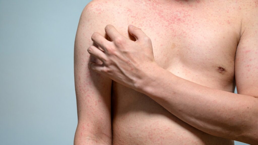 ¿Cuál es el estado del sarampión en México?