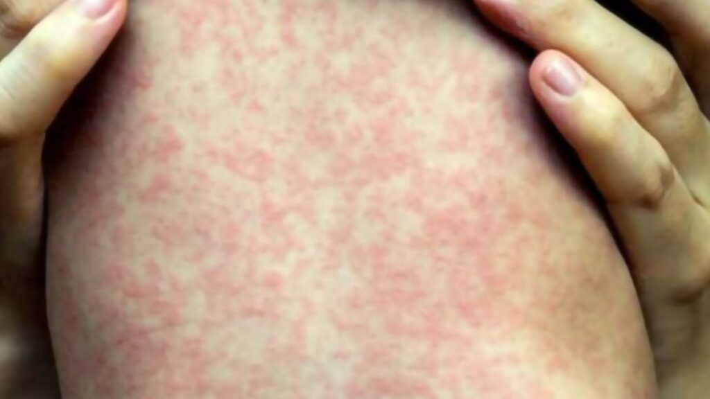 Michoacán registra cuarto caso de sarampión; la nueva víctima, un bebé de un año