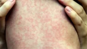 Michoacán reporta primera muerte por sarampión en 2026; registran más de 100 nuevos casos en 24 horas