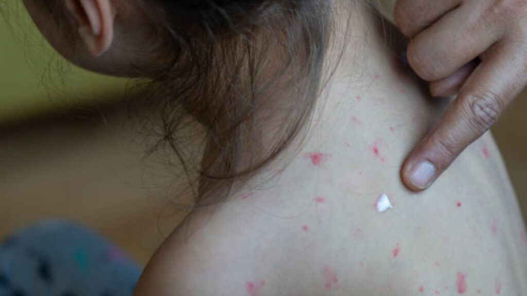 Cinco personas han fallecido por sarampión en México