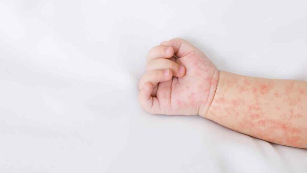 Cuatro fallecimientos por sarampión en Chihuahua; ninguno estaba vacunado