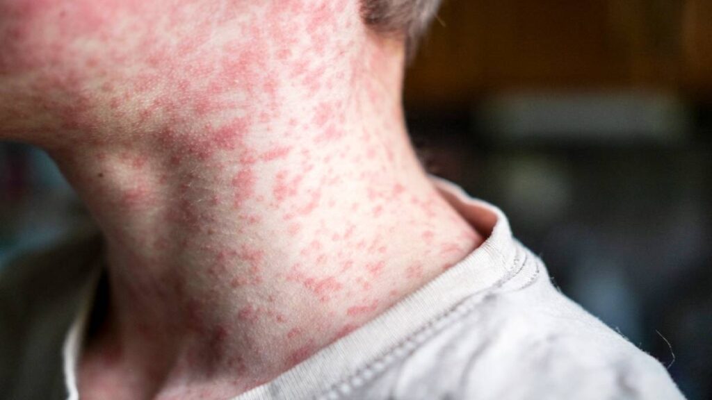 Sarampión en México sube a 2 mil 434 casos; ve número de muertos y estados más afectados