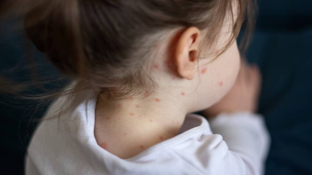 Sube a mil 926 casos de sarampión en México: estados son los estados más afectados