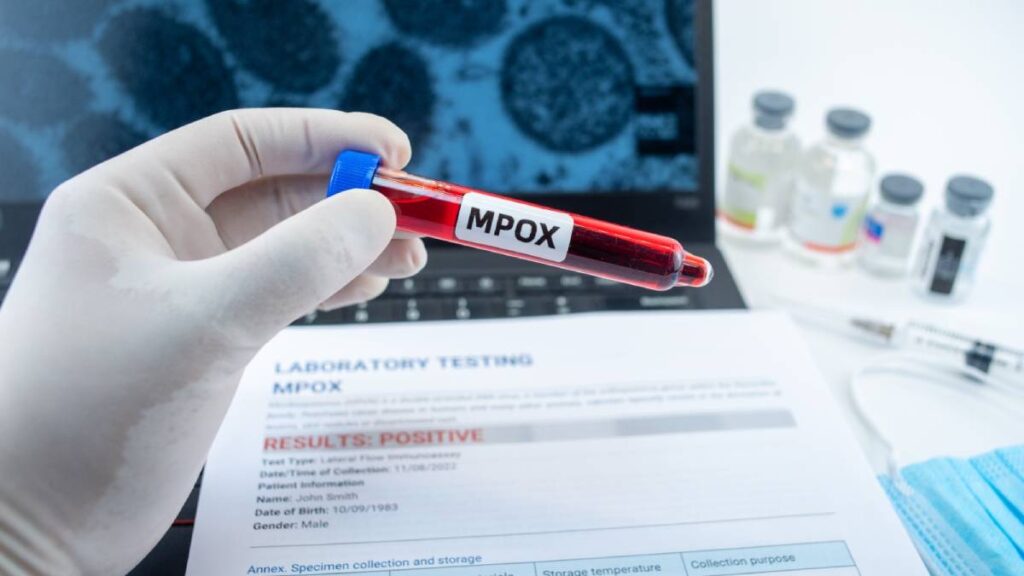 ¿Cuál es el panorama de Mpox en México? Ve síntomas y cómo se transmite