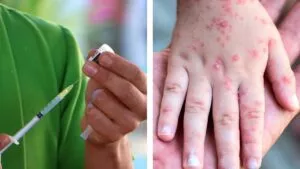 Sarampión en México: en estos lugares puedes tener la vacuna gratis en los 32 estados