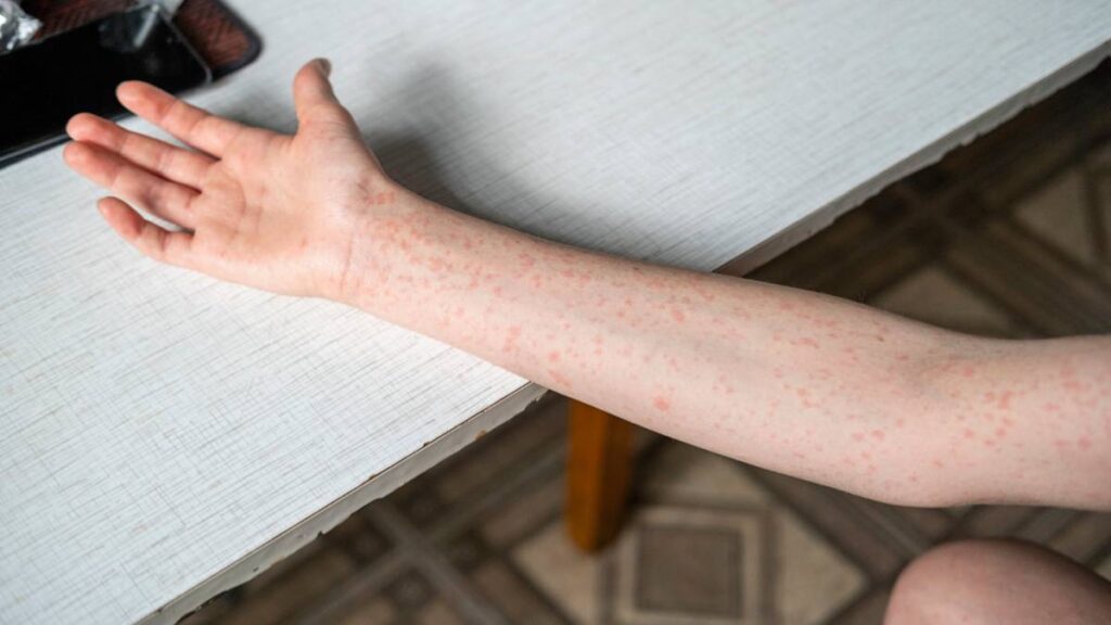 México registra 4 mil casos de sarampión, es el segundo país con más reportes del continente