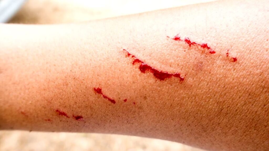 Muere en Zacatecas la adolescente infectada con rabia humana tras mordida de zorrillo