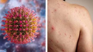 México lidera muertes por sarampión en América: van 19 fallecidos, los más afectados son niños