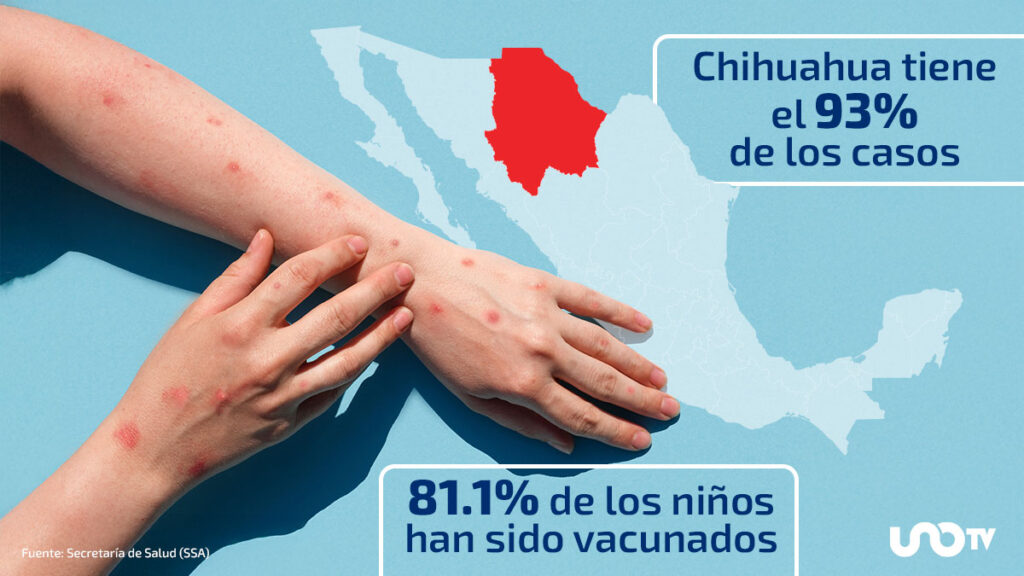 La vacunación es lo único que puede contener al sarampión