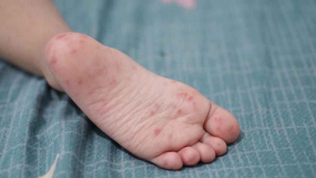 Virus Coxsackie en menores