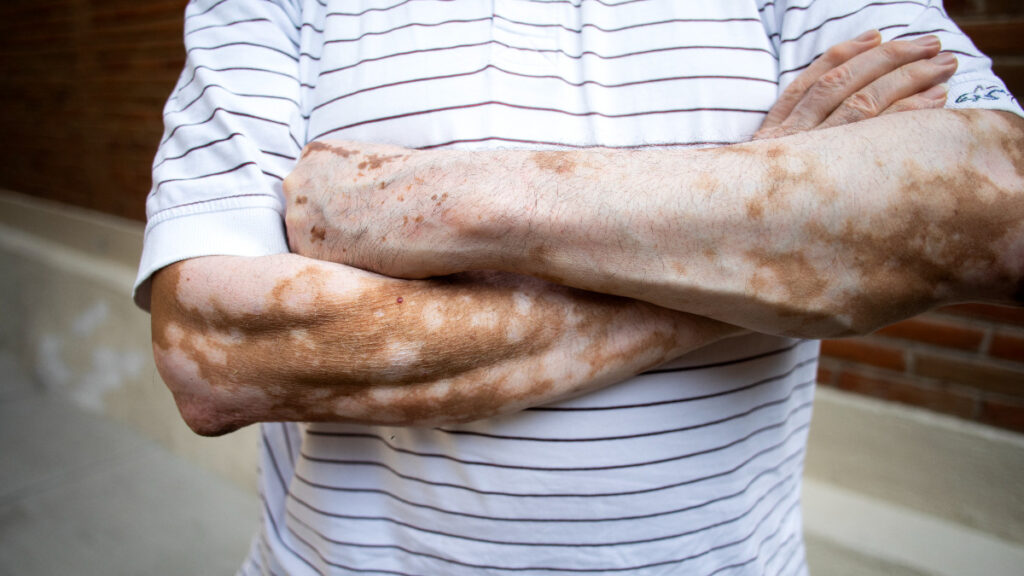 Científicos mexicanos investigan el vínculo de vitiligo y obesidad