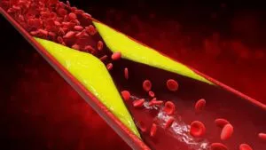 ¿Cuál es el riesgo genético de tener un colesterol peligrosamente alto?