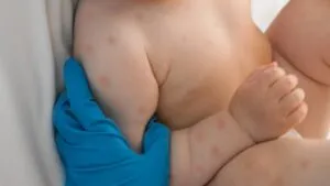 Morelos reporta un nuevo caso de sarampión en una bebé