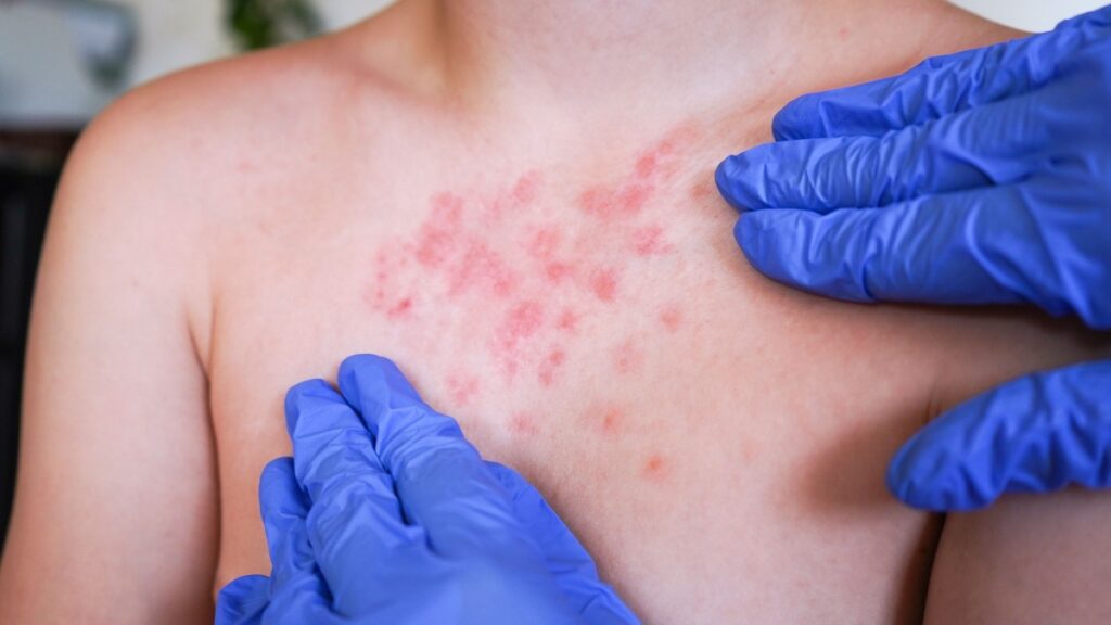 Brotes de sarampión activos en México; síntomas, contagio y cómo protegerte