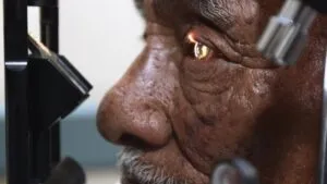 Cataratas en aumento: UNAM alerta que pueden presentarse a partir de los 40 años