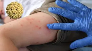 ¡Al alza! México registra el mayor número de casos totales de chikungunya en los últimos seis años