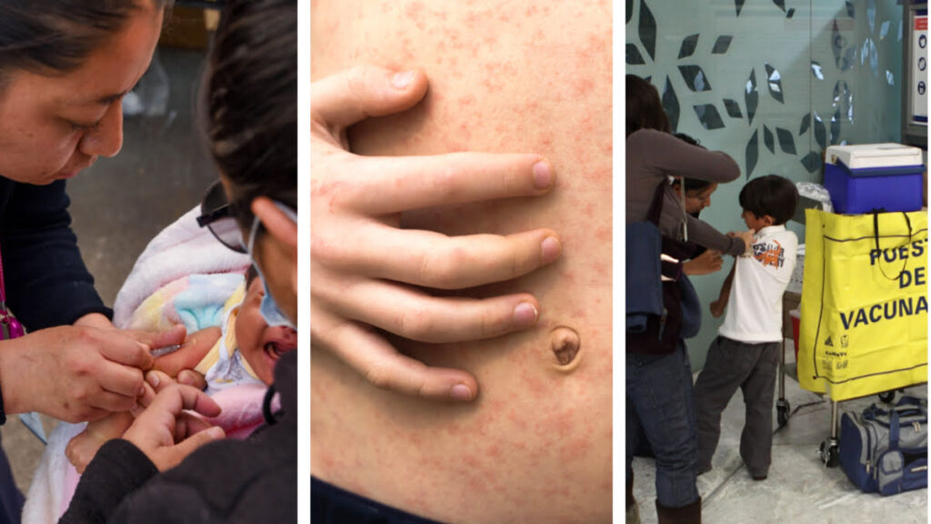 Estados mantienen monitoreo epidemiológico por sarampión.