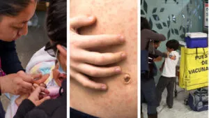 Frente al brote de sarampión en Chiapas: así responden Veracruz, Oaxaca y Tabasco