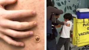 Sarampión en Chiapas: edades, dosis y quiénes necesitan la vacuna