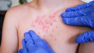 SSA responde sobre brote de sarampión en México: “90% de los casos no contaban con vacunas”