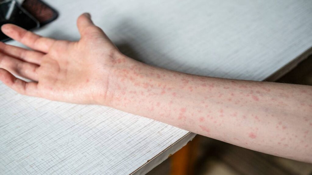 España ya no es país libre de sarampión: OMS le retira estatus y pide reforzar vacunación