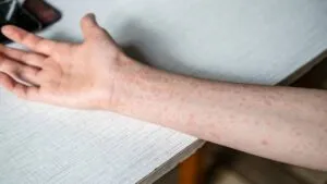 España ya no es país libre de sarampión: OMS le retira estatus y pide reforzar vacunación