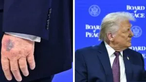 Trump aclara origen de los moretones en su mano derecha