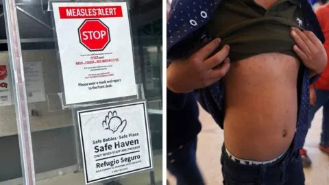 Carolina del Sur enfrenta el peor brote de sarampión en 25 años en Estados Unidos