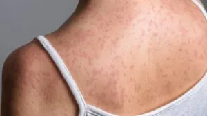 Aseguran que hay suficientes vacunas contra el sarampión; dónde se aplica de forma gratuita