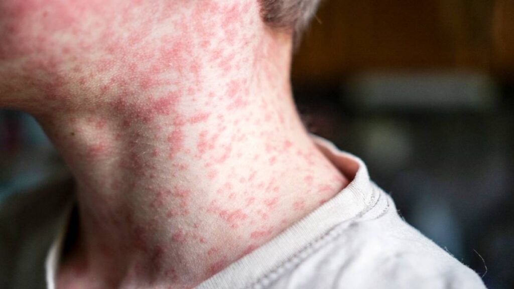 Sarampión es más contagioso que el COVID-19: experto de la UNAM pide evitar remedios caseros